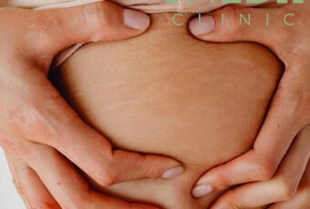 Are stretch marks permanent