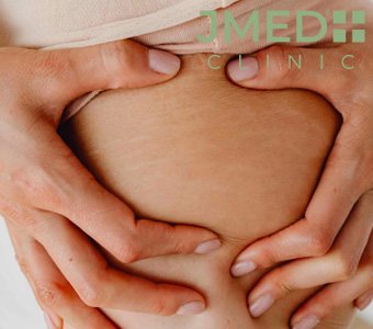 Are stretch marks permanent