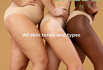 Are there natural ways to get rid of stretch marks