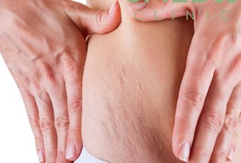 Can Stretch Marks Go Away on Their Own