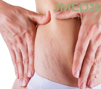 Can Stretch Marks Go Away on Their Own