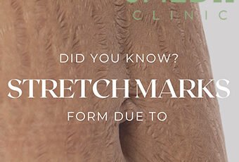 Do Stretch Marks Mean My Skin Is Unhealthy