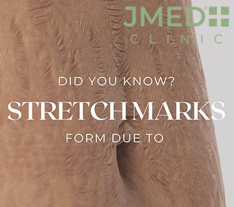 Do Stretch Marks Mean My Skin Is Unhealthy