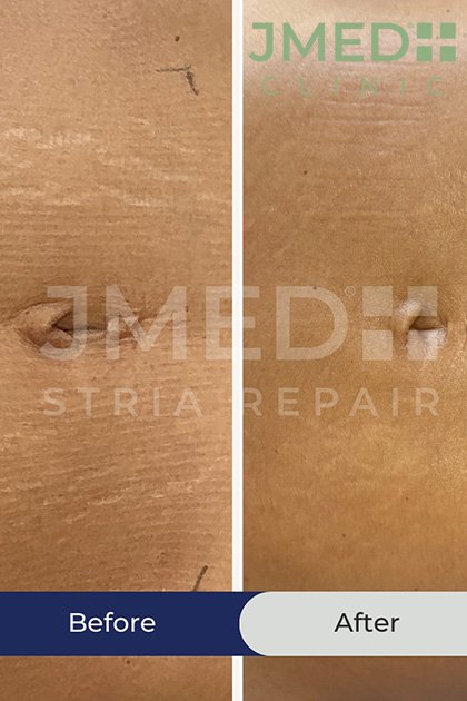 Do Stretch Marks Mean My Skin Is Unhealthy