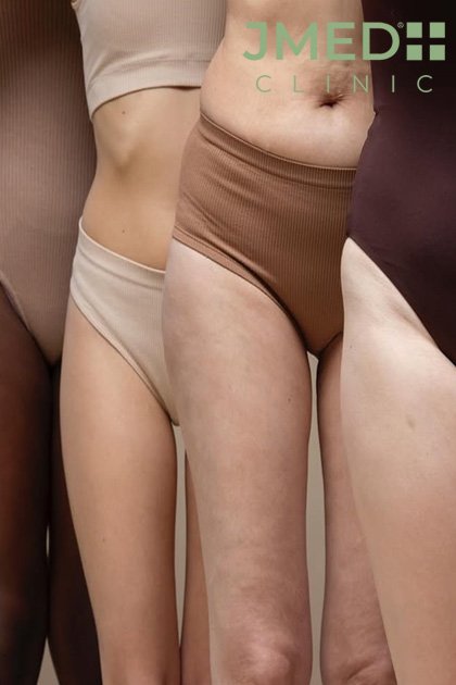 Modern Treatments for Stretch Marks