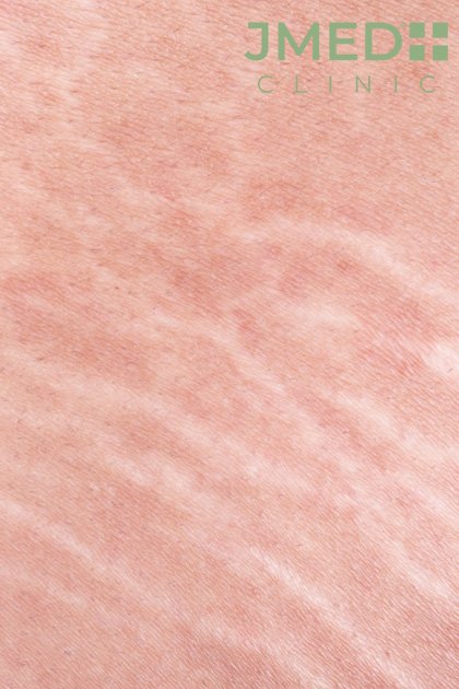 Natural ways to get rid of stretch marks