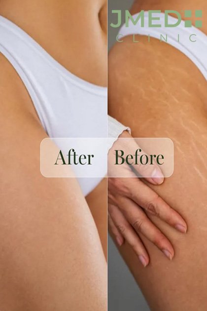 Stretch Marks Removal