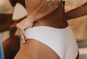 What Causes Stretch Marks During Puberty