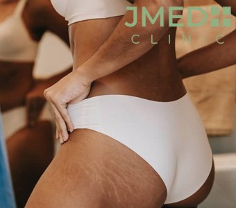 What Causes Stretch Marks During Puberty