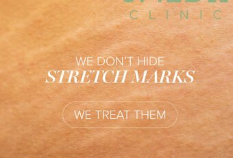 What Is the Best Treatment to Remove Stretch Marks