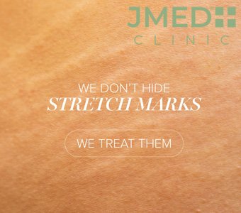 What Is the Best Treatment to Remove Stretch Marks