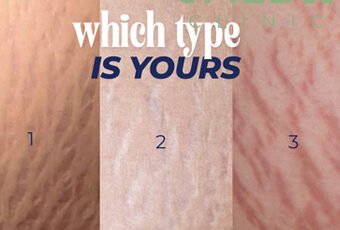 What are stretch marks and why do they appear