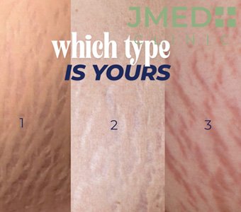 What are stretch marks and why do they appear