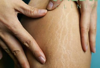 Why Do I Get Stretch Marks Even Though I’m Thin