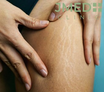 Why Do I Get Stretch Marks Even Though I’m Thin