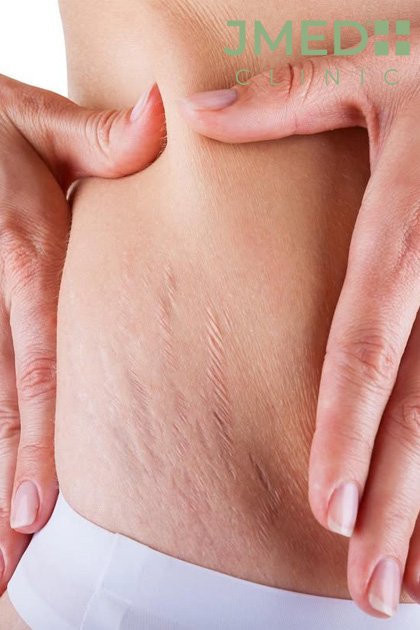 Why Stretch Marks Appear