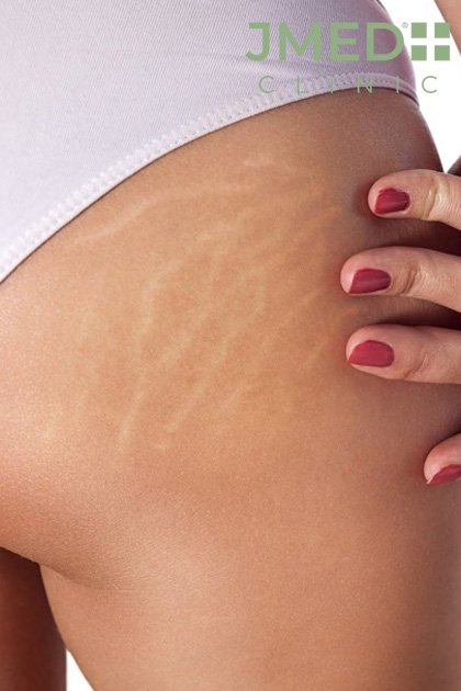 puberty stretch marks removal
