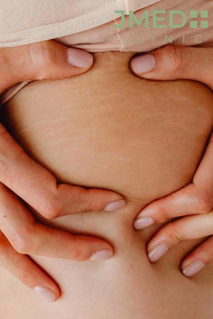 stretch marks removal in Dubai