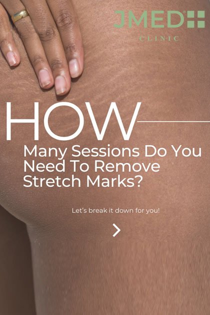 Advanced Treatment Solutions to Help Remove Stretch Marks