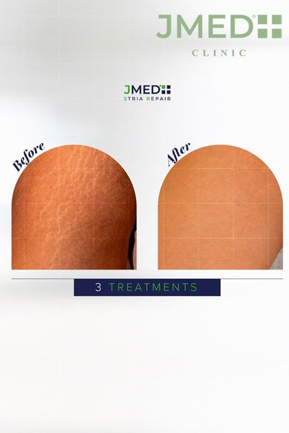 Benefits of Laser Treatment