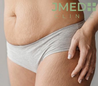 Can Working Out or Gaining Muscle Cause Stretch Marks
