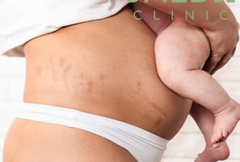 Do Pregnancy Stretch Marks Ever Disappear