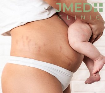 Do Pregnancy Stretch Marks Ever Disappear