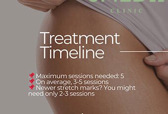 How Long Does It Take To Remove Stretch Marks