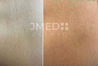 Is Laser Treatment Safe for Stretch Marks