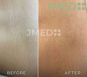 Is Laser Treatment Safe for Stretch Marks
