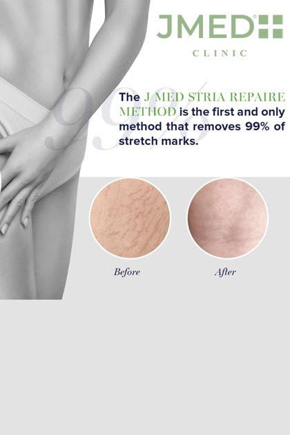 Number 1 Stretch Marks Removal Clinic In UAE Number 1 Stretch Marks Removal Clinic In UAE