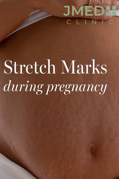 Pregnancy Stretch Marks Removal