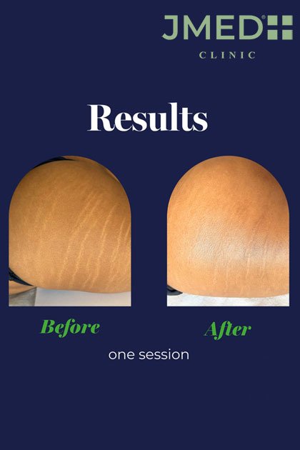 Remove Stretch Marks Timeline