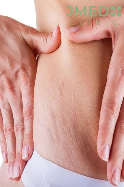 Stretch Marks and Muscle Growth