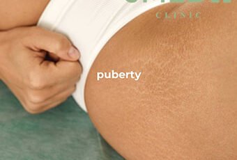 What Is Inkless Stretch Mark Camouflage