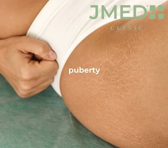 What Is Inkless Stretch Mark Camouflage