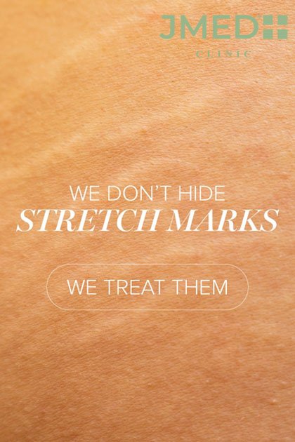 stretch marks removal cost in dubai