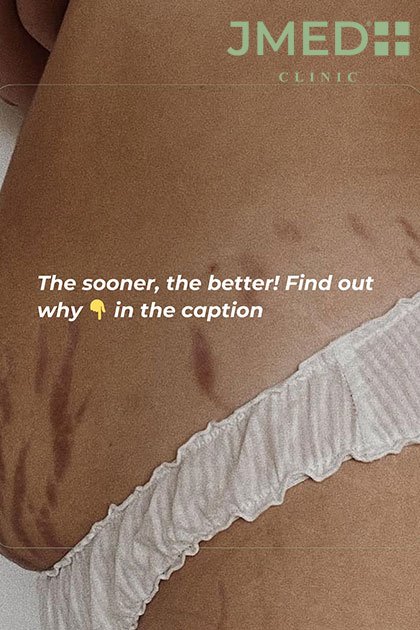 Best Treatment for Stretch Marks