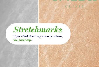 How Do I Get Rid Of Stretch Marks