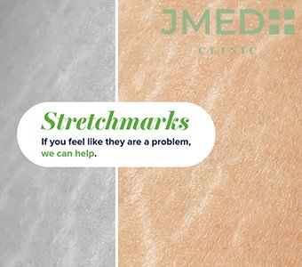 How Do I Get Rid Of Stretch Marks