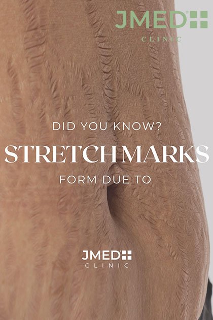 How is the Stria Repair Method a Popular Choice