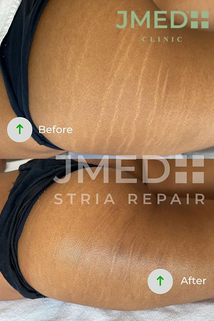 Stretch Mark Removal in Dubai Stretch Mark Removal in Dubai