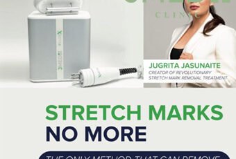 What Is the Best Treatment for Stretch Marks in Dubai