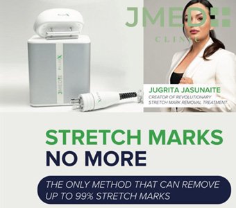 What Is the Best Treatment for Stretch Marks in Dubai