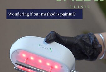 Which treatment is best for stretch marks