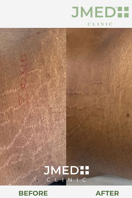 most effective treatment for stretch marks