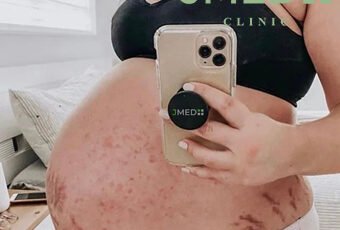 Can You Really Prevent Stretch Marks While Pregnant