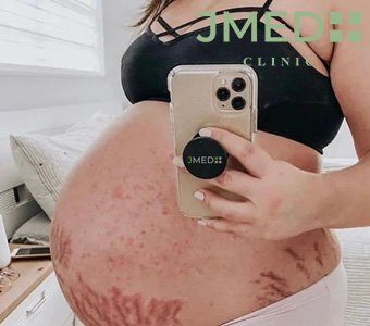 Can You Really Prevent Stretch Marks While Pregnant