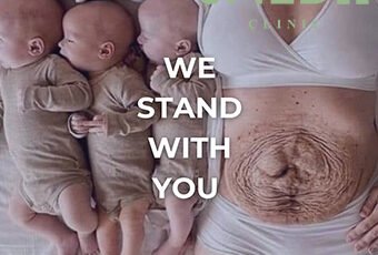 How to Prevent Stretch Marks During Pregnancy