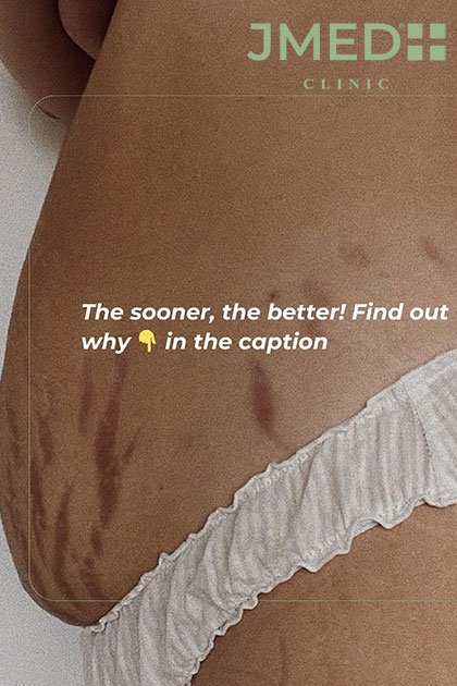 Pregnancy Stretch Marks Removal Pregnancy Stretch Marks Removal